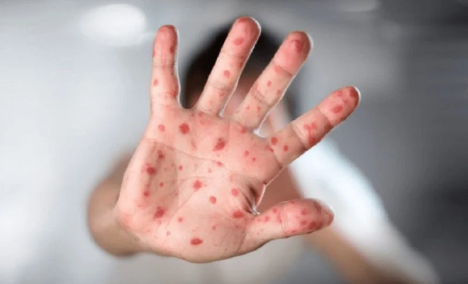 جدري القردة يحصد أرواح 1456 شخصًا في إفريقيا منذ مطلع 2022